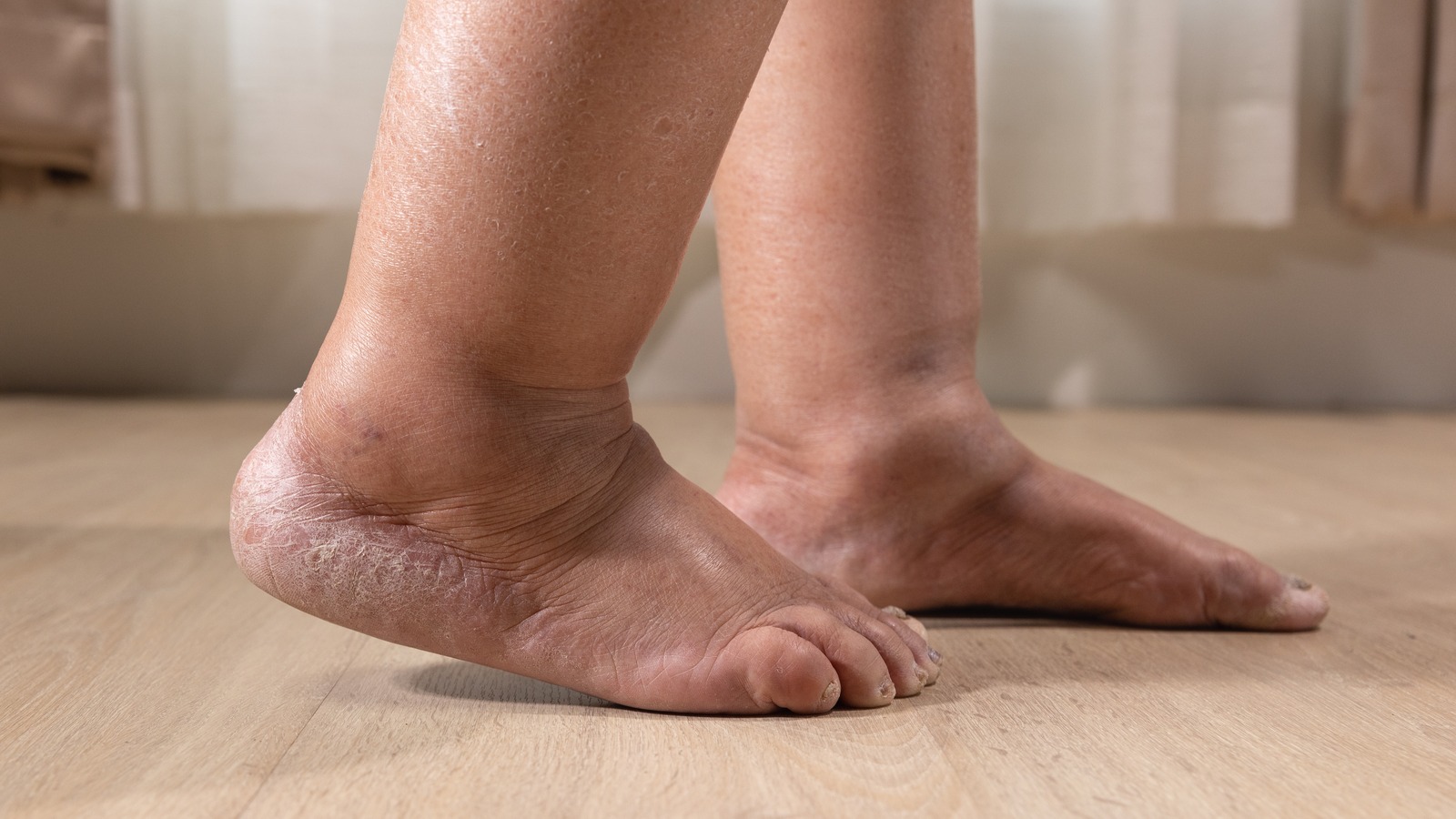 4 Signs Your Swollen Feet Might Require A Trip To The Doctor - Health Digest
