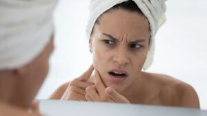 Why A Pus-Filled Pimple Isn't Bad News - Health Digest